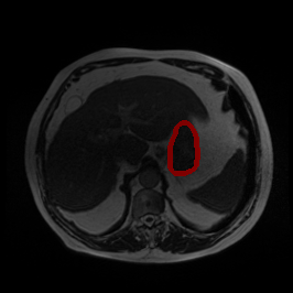 Bias Field Artifact - L1 (Moderate)