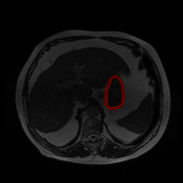 Bias Field Artifact - L2 (Severe)