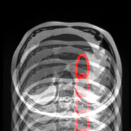 Ghosting Artifact - L2 (Severe)