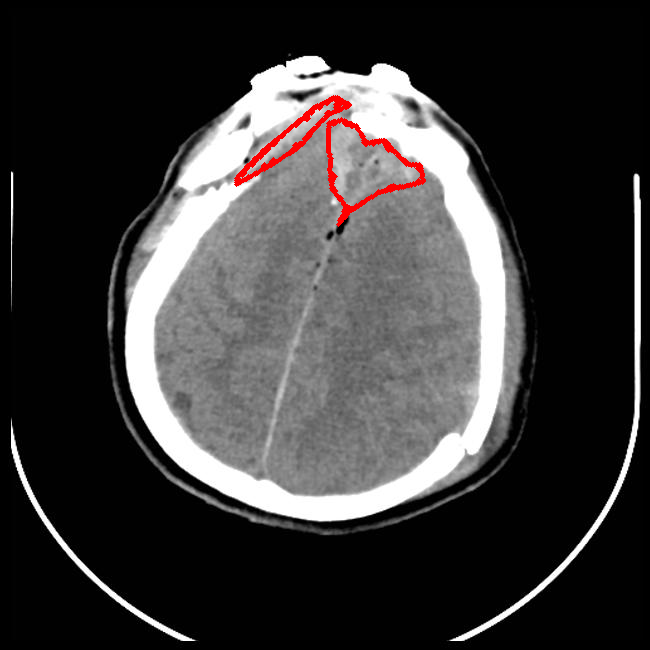 Limited Angle - L0 (Original)