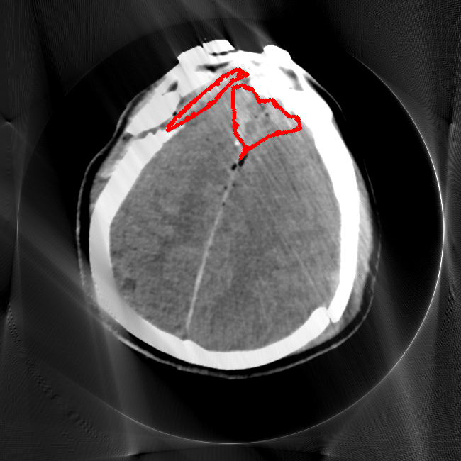 Limited Angle - L1 (Moderate)