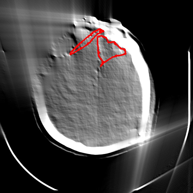 Limited Angle - L2 (Severe)