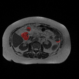 Low Dose - L2 (Severe)