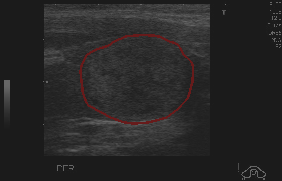 Reduce Contrast - L2 (Severe)