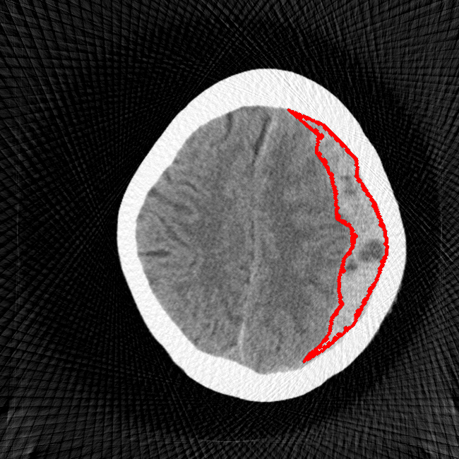 Sparse View - L1 (Moderate)