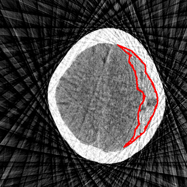 Sparse View - L2 (Severe)