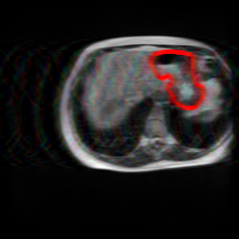 Undersampling Artifact - L1 (Moderate)
