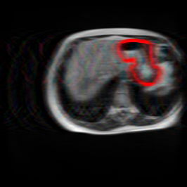 Undersampling Artifact - L2 (Severe)