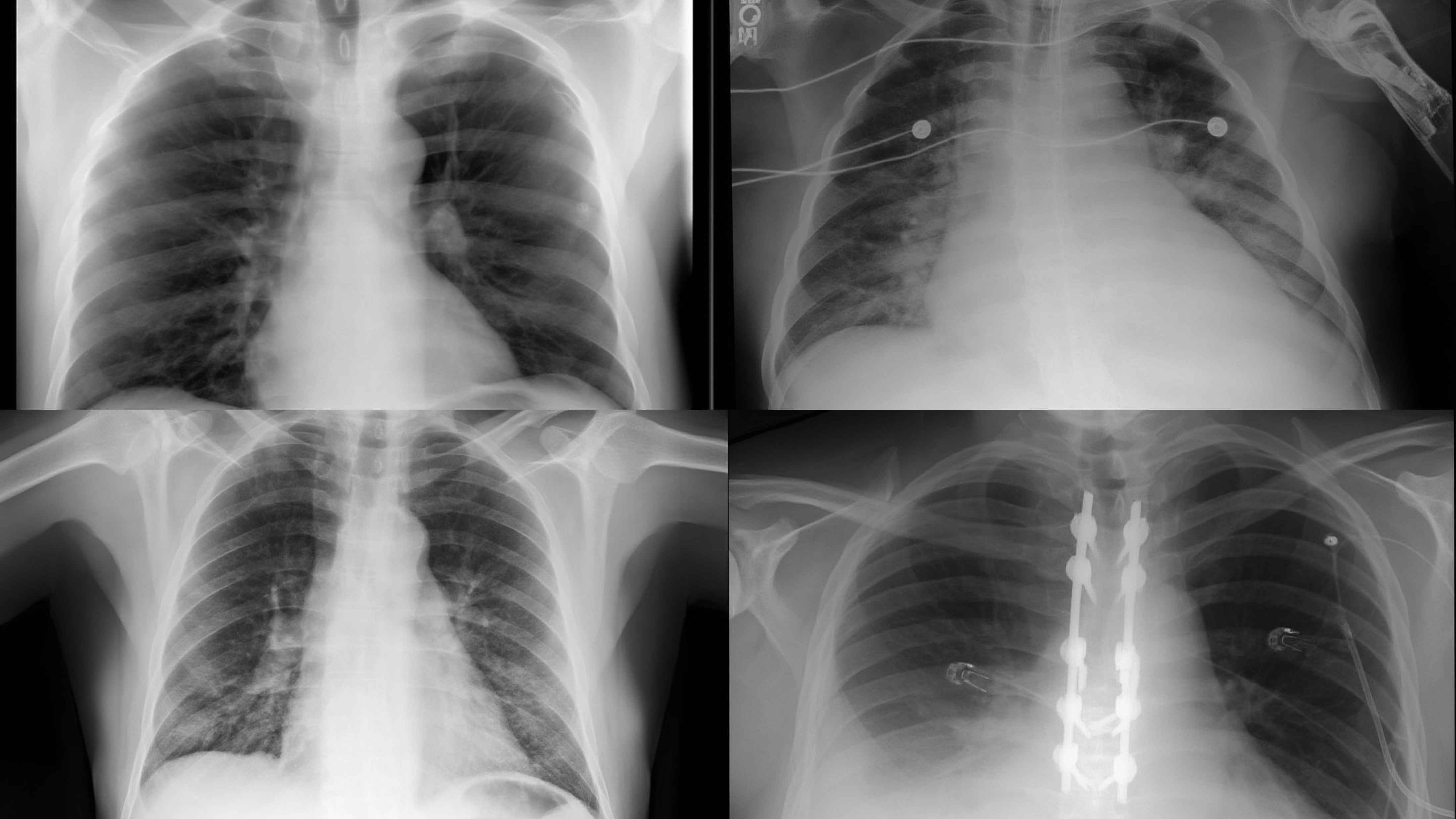 Chest X-ray