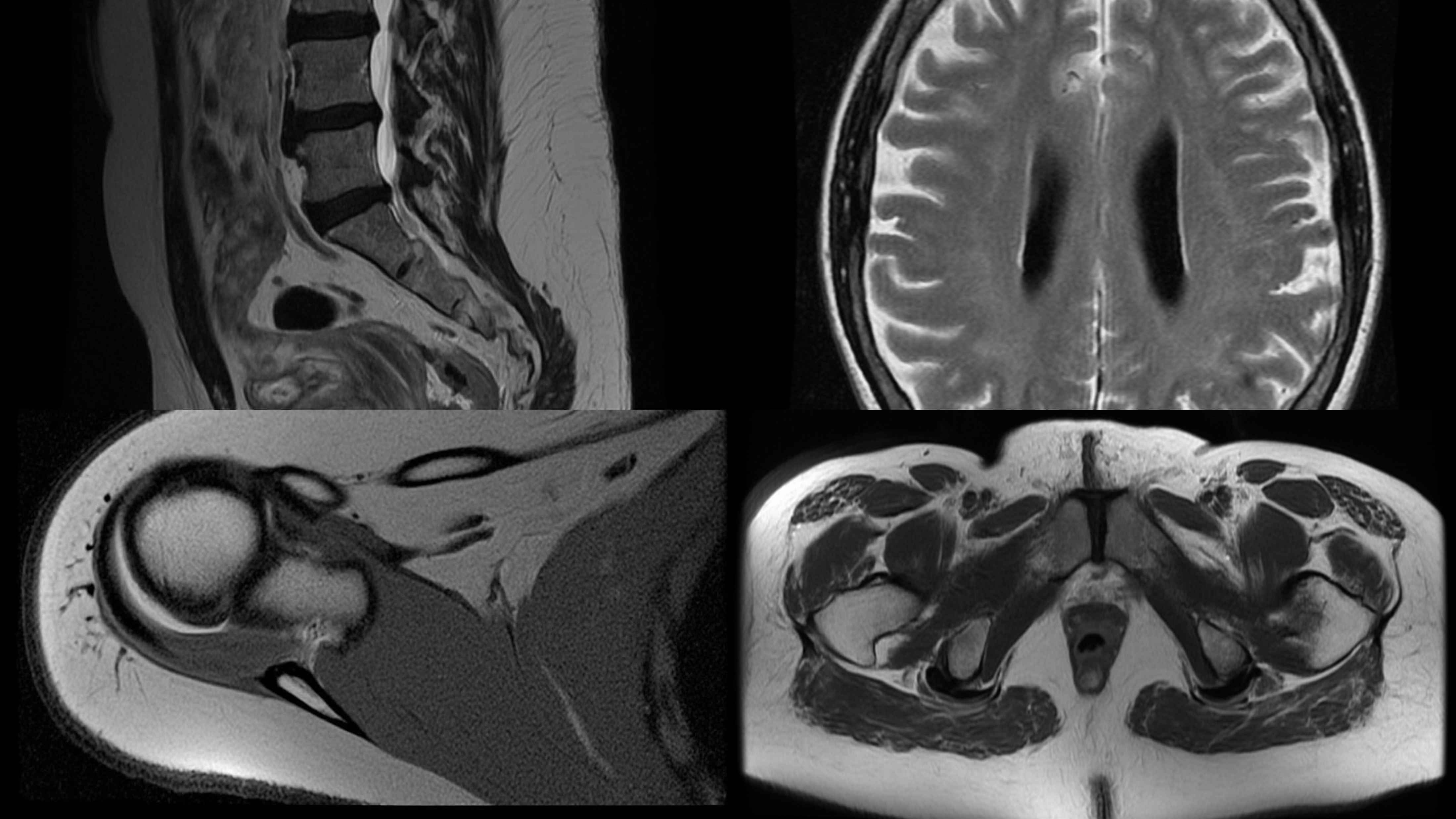 MRI