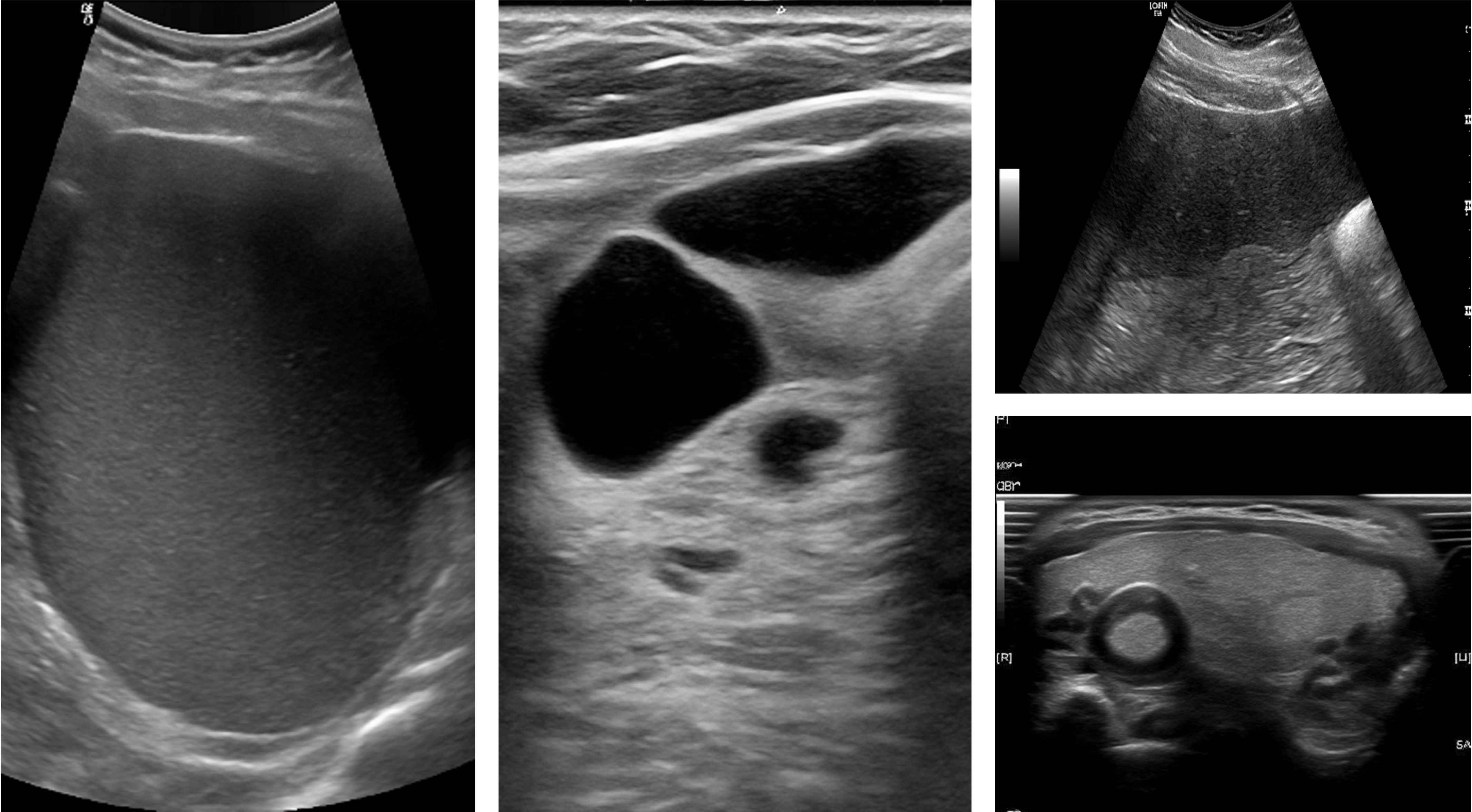 Ultrasound