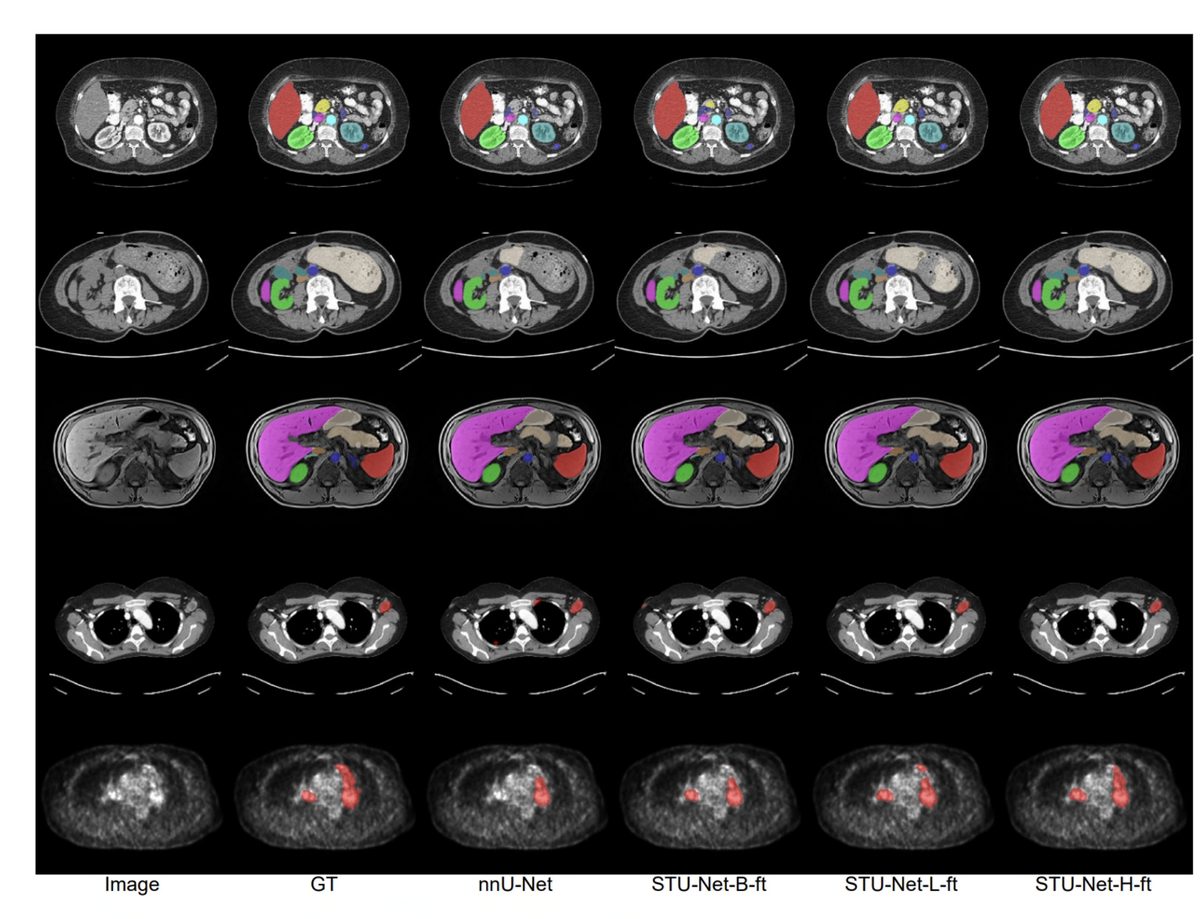 STU-Net qualitative CT segmentation results